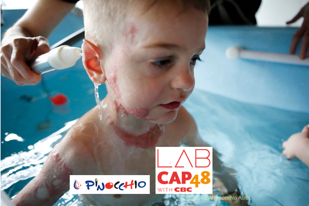 Aidez les enfants brûlés – Crowdfunding avec LabCap48